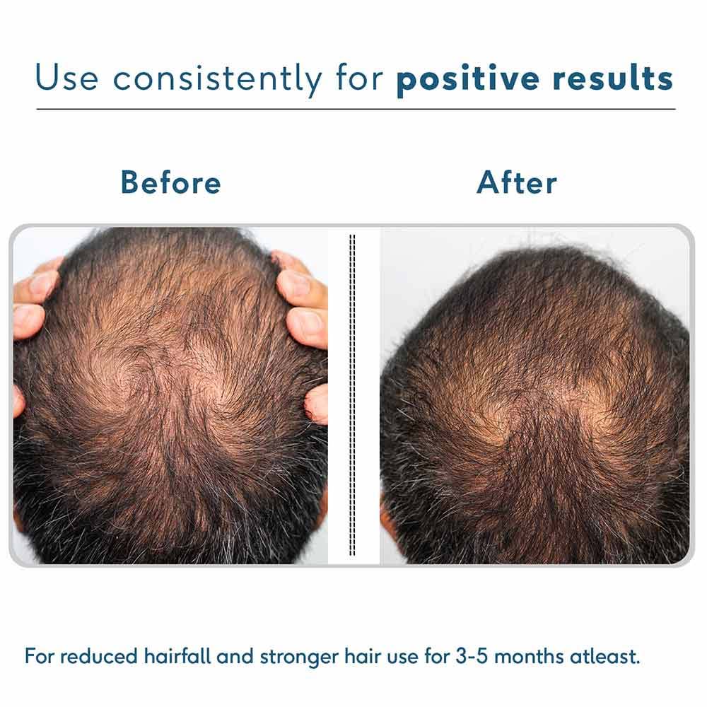 HK Vitals Advanced Hairloss Kit by HealthKart 3 Piece(s)/Pack Combo