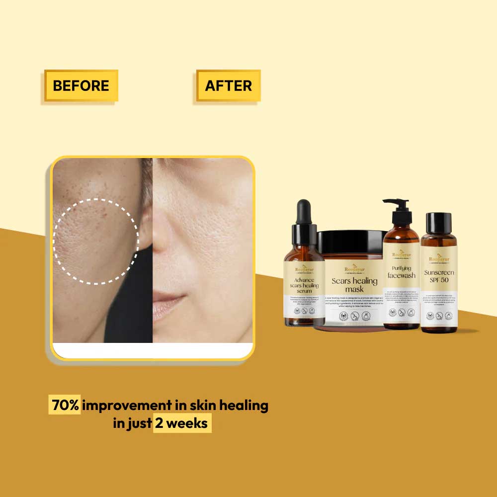 3 - Roopayur Advance Healing Combo,  5 Piece(s)/Pack  Purifying Facewash, Advanced Scars Healing Serum & Mask, Sunscreen SPF 50, Pore Minimizing Toner 