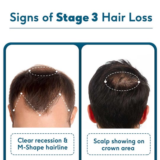 4 - HK Vitals Hair Fall Solution,  STAGE 3